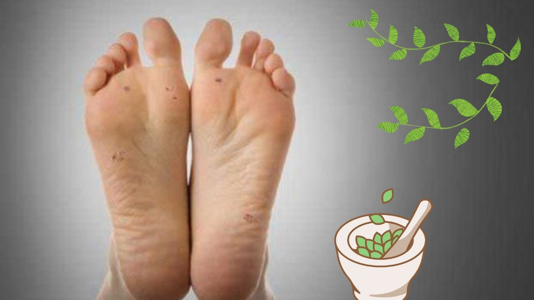 All You Need To Know About Plantar Warts and Their Homeopathic Treatment
