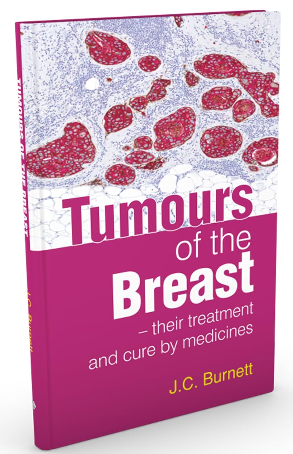 Tumours Of The Breast And Their Treatment And Cure By Medicine