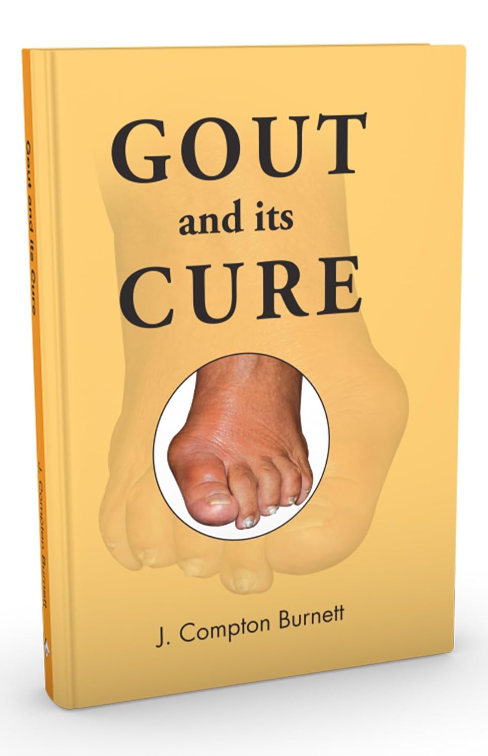 Gout & Its Cure